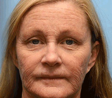 🌟Hergestellt in Deutschland✨Furzero™ Botox Bienenvenom Faltencreme🔥Letzter Tag der Aktion! 70 % Rabatt